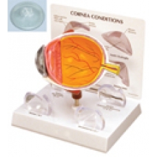 Model de ochi cu afectiuni corneene